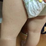 突発性発疹(1歳8ヶ月男児の場合)